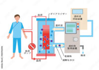 人工透析について